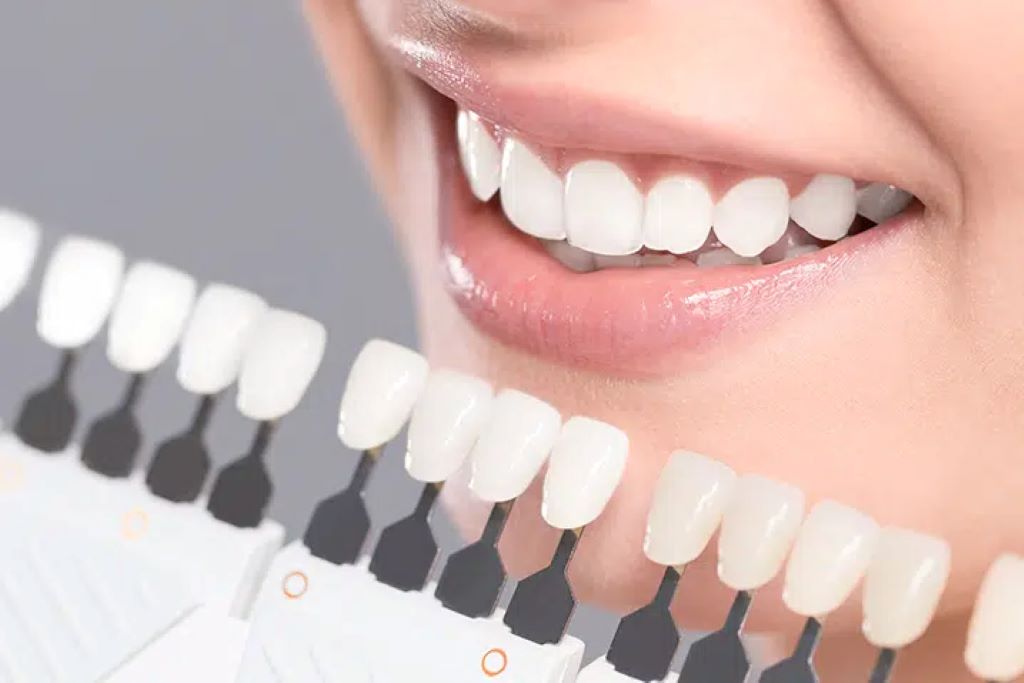 How to keep teeth white after whitening