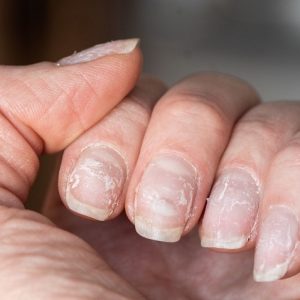 Why Are My Nails So Damaged